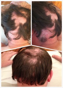 alopecia f1